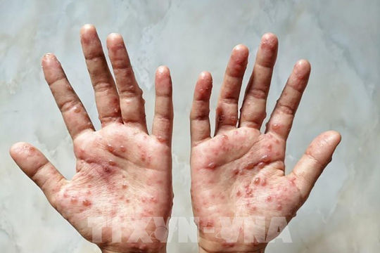 Bộ Y tế thông tin về ca mắc đậu mùa khỉ đầu tiên tại Việt Nam